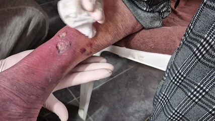 Medical professional cleans and disinfects a large, infected cut on a patient's leg, ensuring proper hygiene and care