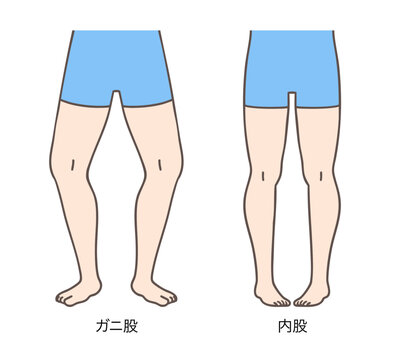 ガニ股と内股の女性、下肢の外旋と内旋