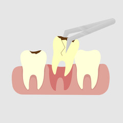 vector illustration of a cavity being extracted