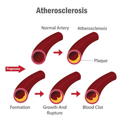 Atherosclerosis Stages Infographic Showing Artery Plaque Formation, Growth, Rupture, and Blood Clot Development in Human Circulatory System. Atherosclerosis stages with artery plaque formation.

