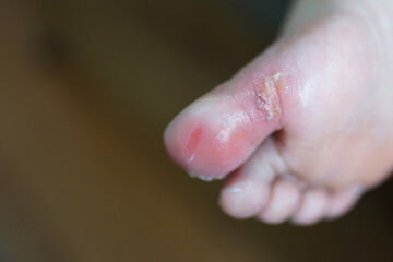 Elevated close-up view of a person's infected ingrown toenail on the floor 
