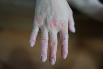 
Itching on hands with redness rash. Cause of itchy skin include dermatitis (eczema), dry skin, burned, food,drug allergies, insect bites. Health care concept.