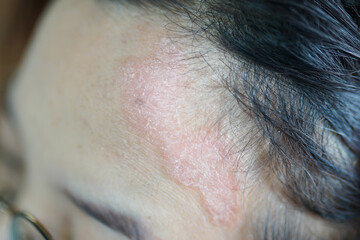 Dermatological skin disease. psoriasis, eczema, dermatitis, allergies. Skin lesions on the head. 
