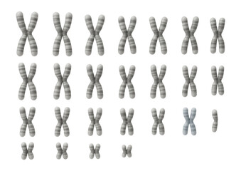 Human karyotype showing trisomy 21 with an extra chromosome in the 21st pair