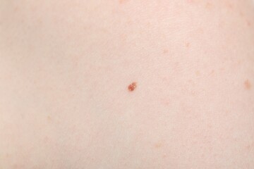 Woman with mole on her body, closeup