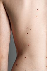 Man with moles on his body against grey background, closeup
