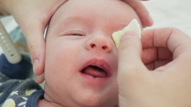 parent cleans eye mucus with a sterile cotton pad from baby eyes in selective focus. Disease tear ducts tons of newborns close up. blockage of the lacrimal drainage system. 