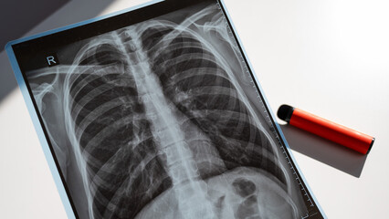 Disposable Vape and Lung X-Ray. 