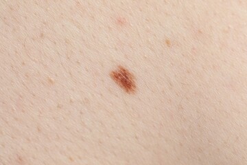 Woman with moles on her body, closeup