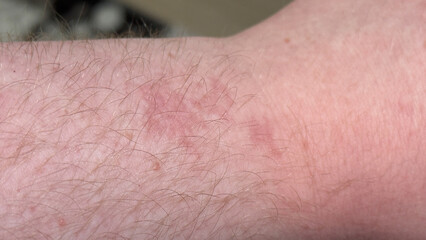 Allergic reaction with hives and dermatitis on the forearm of a caucasian man with sensitive skin