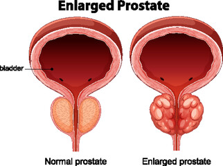 Comparison of Normal and Enlarged Prostate Anatomy