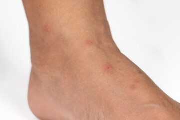 Close up view of flea bites on lower legs and feet skin.