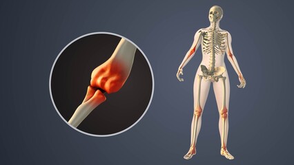 Degenerative Arthritis Affecting Inner elbow Joint Spaces