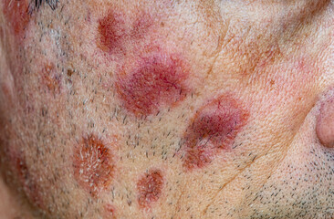 A case of cutaneous sarcoidosis on the face of a man, close up view
