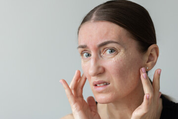 Pain after biorevitalization. Woman has pain after skin face biorevitalization