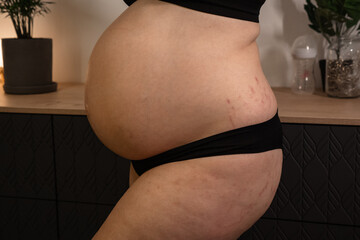 Pregnant woman at 9 months of pregnancy showing stretch marks on belly and leg close up. Body positive. Anticipation getting ready for the maternity
