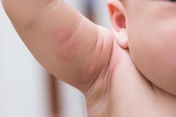 Infant showing red rash on soft skin
