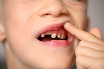 Boy lifts lip with finger, opens mouth to show loose baby tooth and erupting front permanent tooth...
