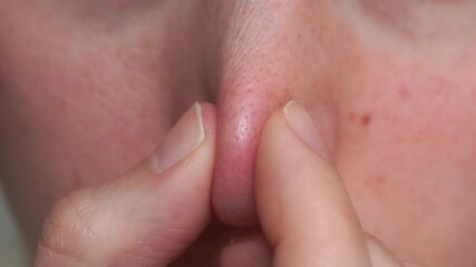 Macro video of finger pressing nose skin to squeeze clogged pore. Ideal for dermatology, skincare tutorials, cosmetic procedures, acne treatment and beauty content.