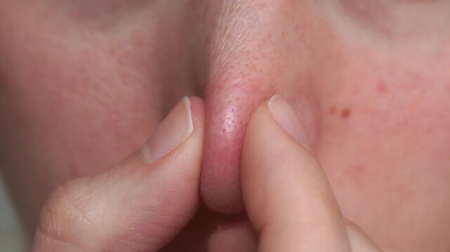 Macro video of finger pressing nose skin to squeeze clogged pore. Ideal for dermatology, skincare tutorials, cosmetic procedures, acne treatment and beauty content.