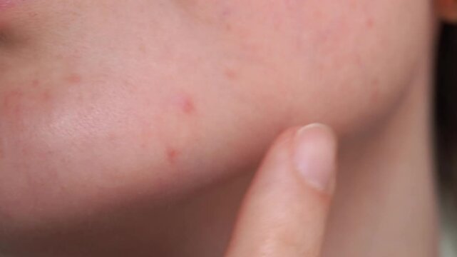 Macro video of cheek with visible pores, acne marks, and finger pressing skin. Great for skincare, dermatology, beauty tutorials, and facial treatment visual explanations.