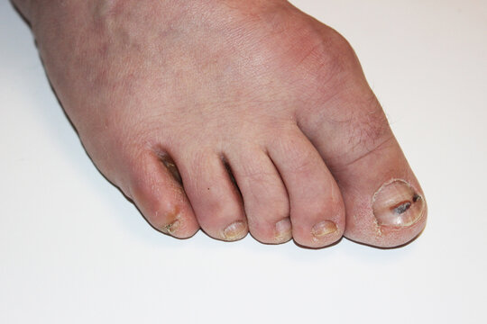 Onychomycosis of the nails and feet. Treatment, diagnostics calluses, corns, fungus. Podologist, podiatry. Nail diseases