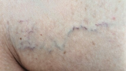The image shows spider veins on skin, characterized by small, dilated blood vessels visible near the surface.