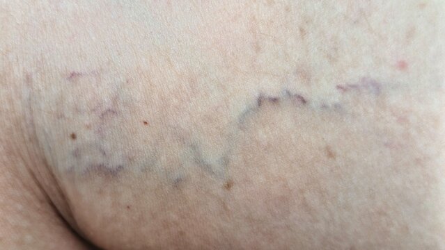 The image shows spider veins on skin, characterized by small, dilated blood vessels visible near the surface.