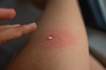 Closeup of woman finger applying clear gel to red swollen skin after wasp sting. Allergic reaction...
