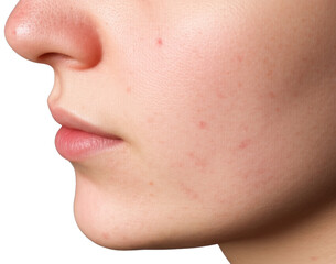 Close-up of a person's face with skin imperfections against a light background, transparent background png
