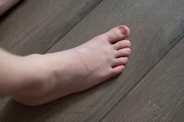 A child's feet with nibbled nails. Neurology