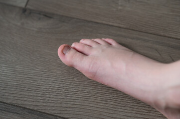 A child's feet with nibbled nails. Neurology