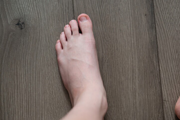A child's feet with nibbled nails. Neurology