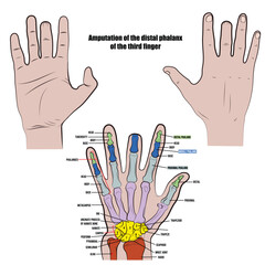 Amputated middle finger, hand X-ray.