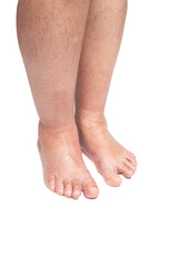 Swollen leg caused by a broken toe. Unrecognizable man with swollen feet, tired and painful legs.Edema lower limbs