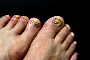 足　指　爪　水虫