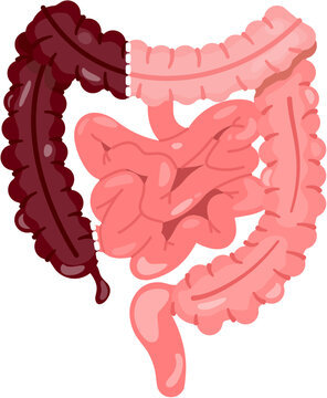 Right Hemicolectomy 