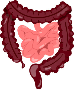 Total Proctocolectomy