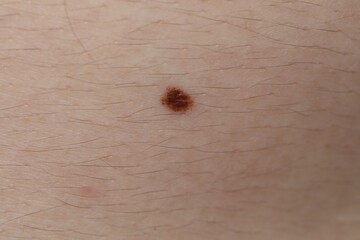 Man with mole on his body, closeup