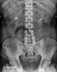 KUB (Kidneys, Ureters, Bladder) x ray showing bilateral renal calculi 