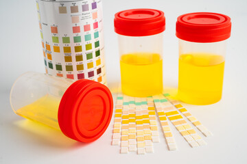 Urinalysis, urine cup with reagent strip pH paper test and comparison chart in laboratory.