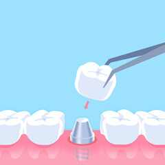Dental Implant - Text box banner (square) illustration vector design. Dental care concept.