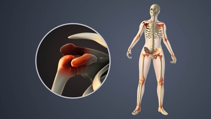 Degenerative Arthritis Affecting Inner Shoulder Joint Spaces