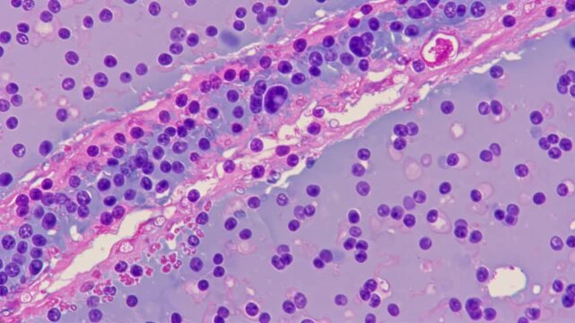 Histopathology - Cervical cells showing dysplasia (Pap smear)