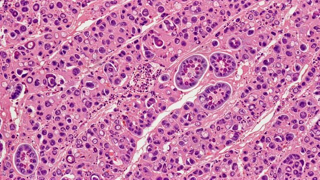 Infectious - Hepatitis B virus-infected liver histology