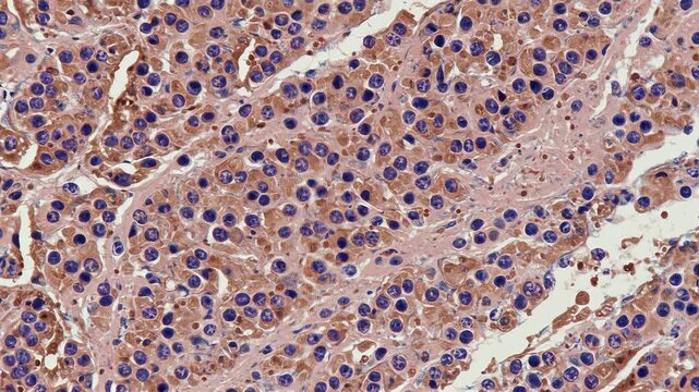 Neuropathology - Neuroblastoma tissue structure