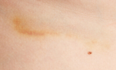 A person's arm has a small scar