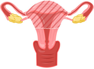 Partial Hysterectomy 
