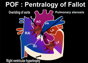 the structure of pentalogy of fallot that show the 5part defect of heart which is overriding of aorta , pulmonary stenosis  ,VSD, right ventricular hypertrophy,ASD for medical concept