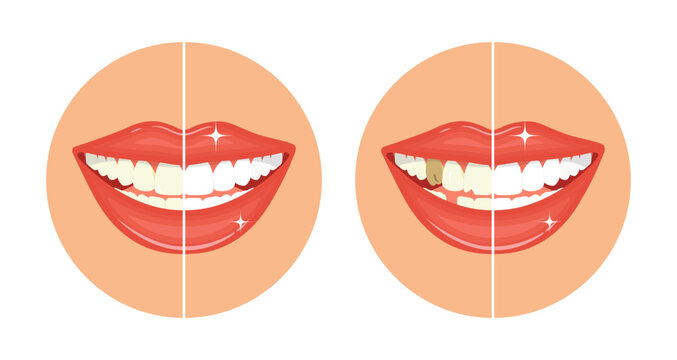 Comparison bleaching teeth treatment. Whiten teeth before and after. Dental care concept. Imperfect smile. Clean and healthy. Illustration of an open perfect female white smile. 